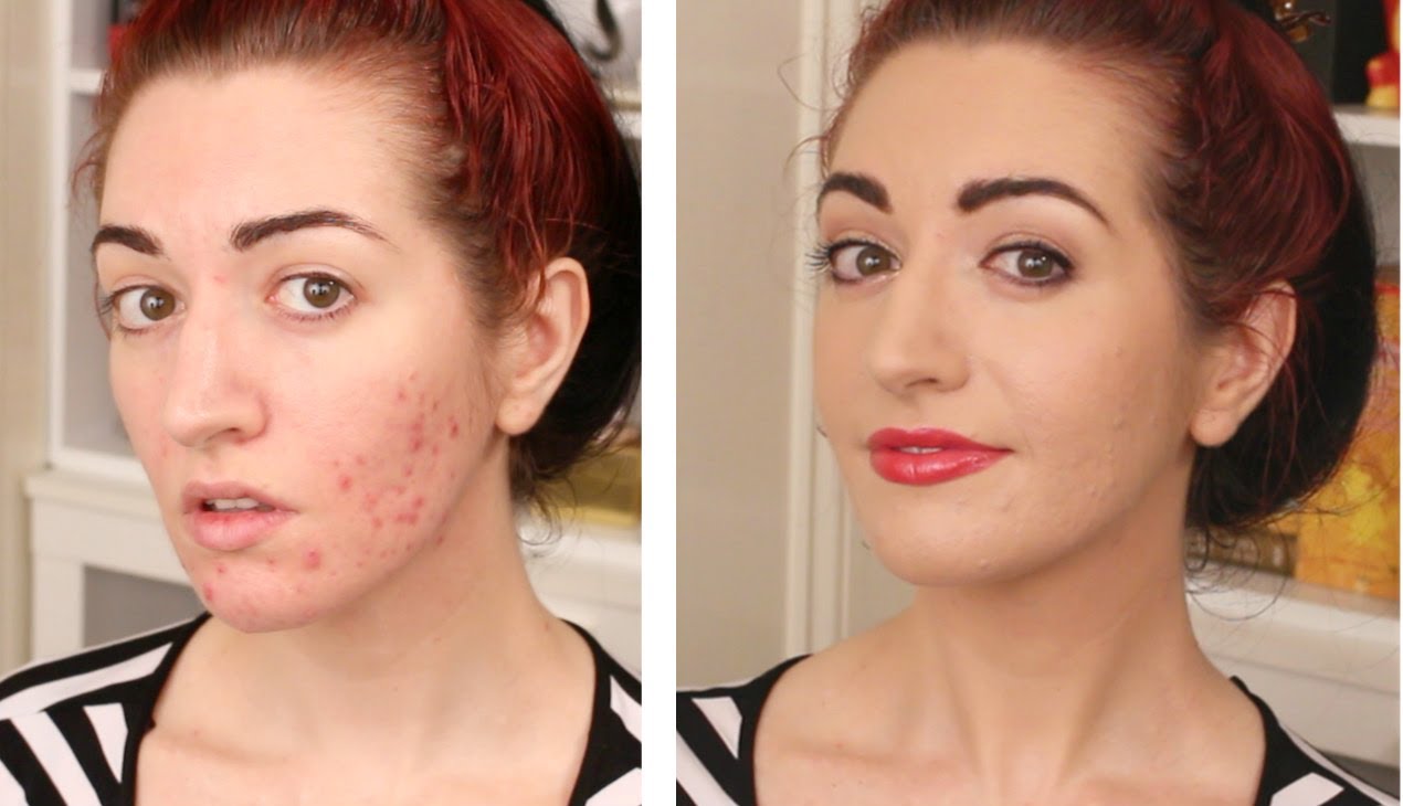 How To Cover Acne And Scarring • My Full Coverage Foundation Routine Makeup Vlog
